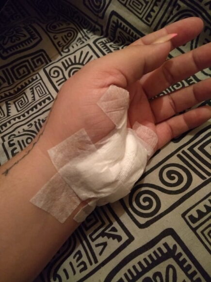 ảnh bị đứt tay troll người yêu băng bó lòng bàn tay