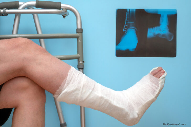 Hình ảnh đau chân bó bột