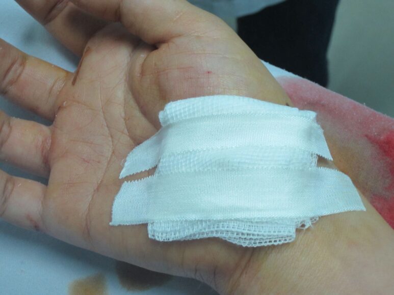 ảnh bị ngã đau ở tay