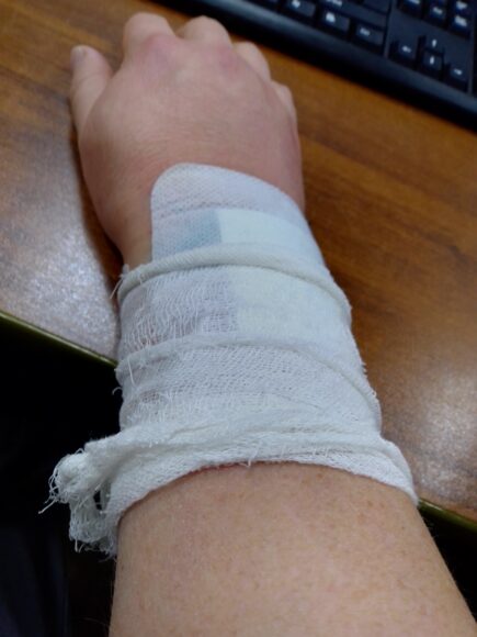 ảnh bị thương cánh tay