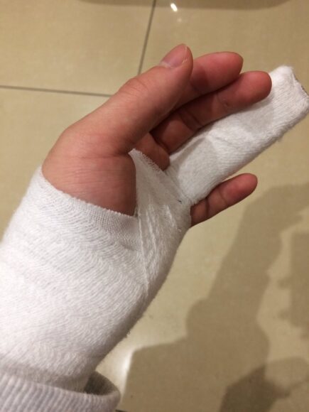 ảnh bị thương tay băng bó