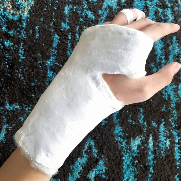 hình ảnh bị thương bó bột