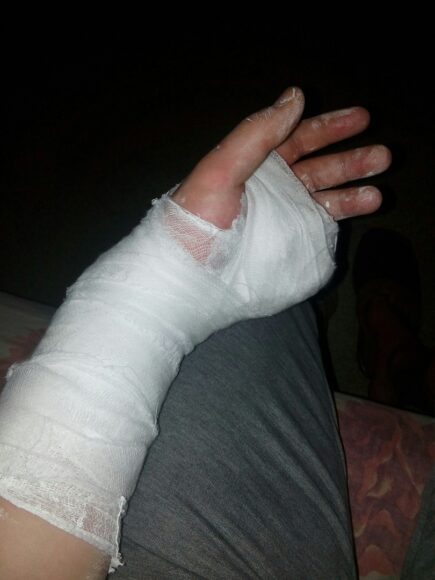 hình ảnh bị thương đứt tay