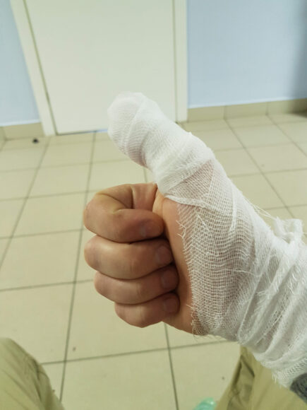 hình ảnh bị thương ở tay