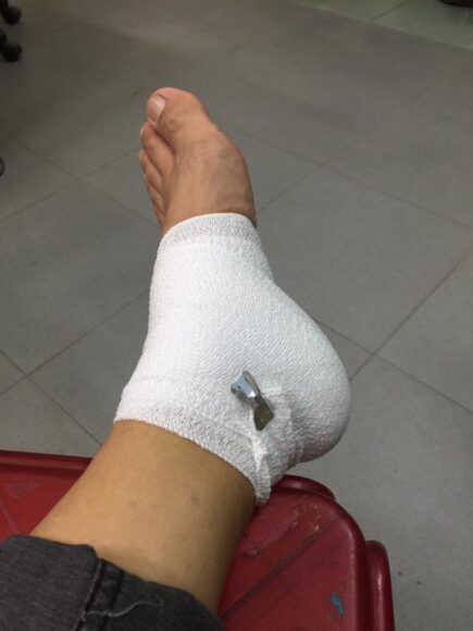 hình bị thương ở chân