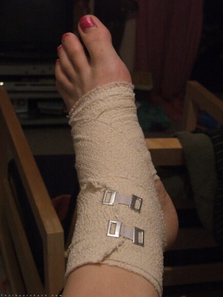 hình ảnh đau chân do vết thương